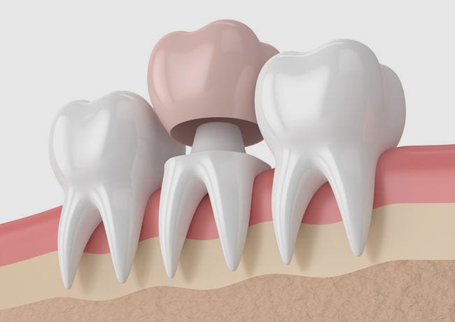 A 3D infographic shows the inner parts of a tooth crown and how it affixes to the base of a tooth.