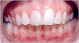 Home 8 Closeup of a patient's mouth reveals an overbite, some discoloration in the teeth, and receding gums.