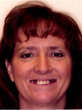 A patient has four upper front teeth and no other teeth visible to the viewer as she prepares to receive dental implants.