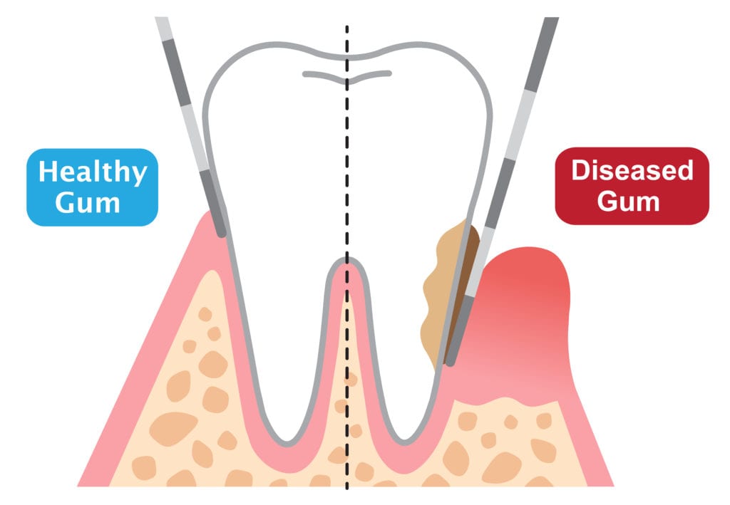 Healthy gum versus a diseased gum.
