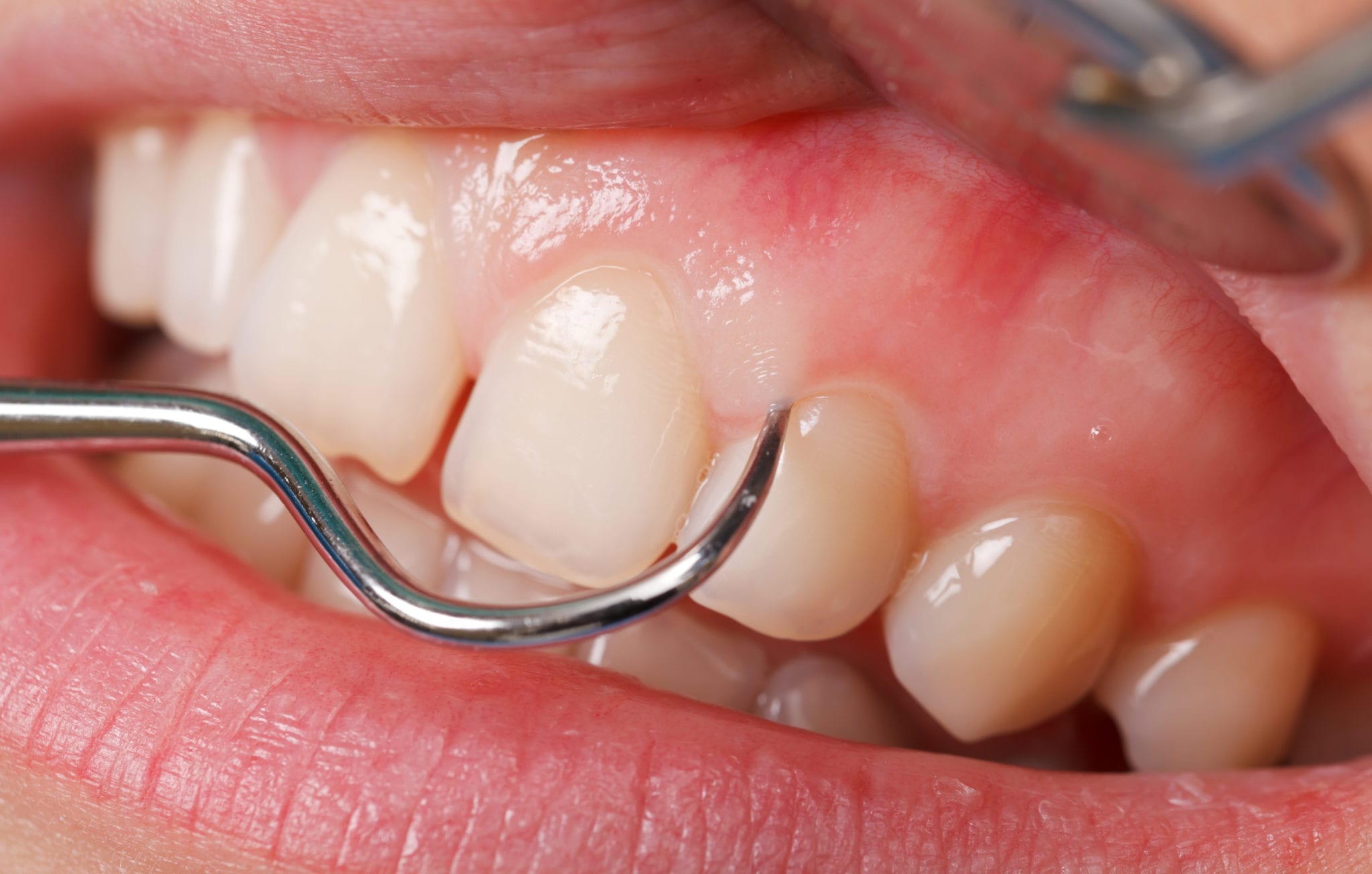 Closeup of teeth receiving a dental cleaning.