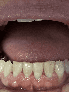 After photo of composite bonding with lower teeth white and shiny.
